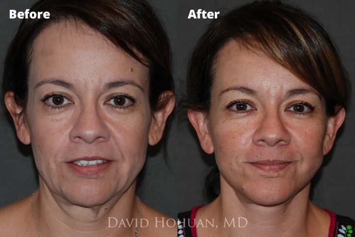 Lower Facelift Yuma AZ