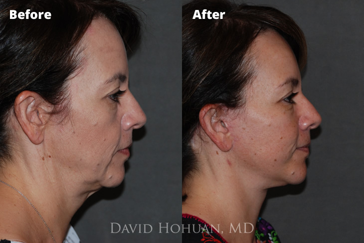 Lower Facelift by Dr. Hohuan