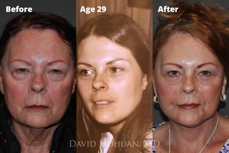 Before and After Facelift and Age 29