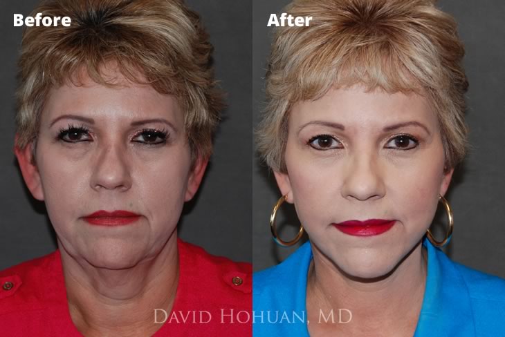 Facelift Browlift by Dr. David Hohuan