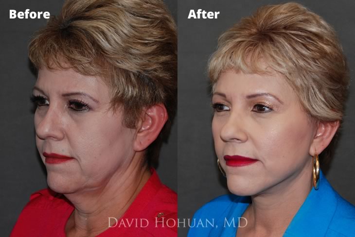 Face and Browlift Lift