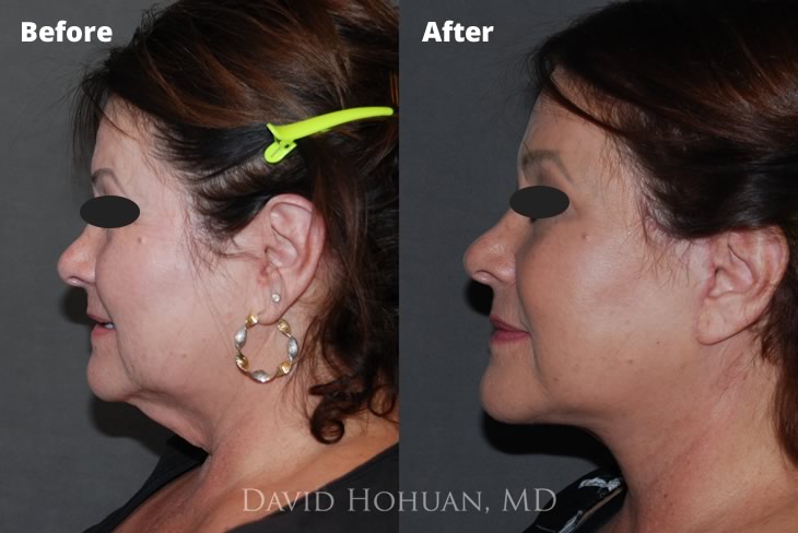 Facelift Browlift by Dr. David Hohuan