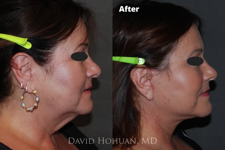 Oblique Face and Browlift Surgery