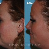 Diagnosis: Nasal Trauma, Droopy Tip, Crooked Nose, Dorsal Hump
Procedure: Rhinoplasty
Technique: Open Nasal Septal Reconstruction, Tip Refinement using Control Columellar Strut and Tip Suture Techniques, Conservative Hump Reduction using Ultrasonic Bone Aspirator.